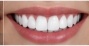 Smile Makeover - After