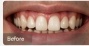 Smile Makeover - Before