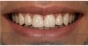 Dental Implants - After