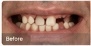 Dental Implants - Before