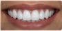 Teeth Whitening - After
