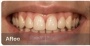 Teeth Whitening - Before